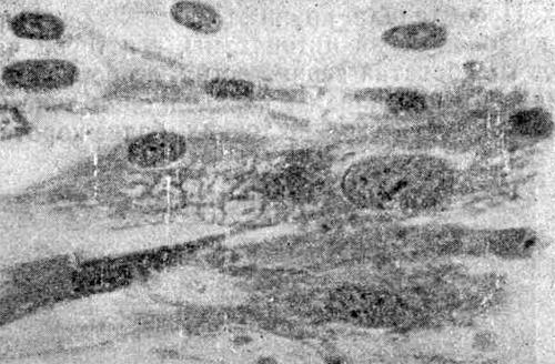 Вакуолизация цитоплазмы клеток в контрольной культуре симпатобластомы; хорошо видны ядрышки