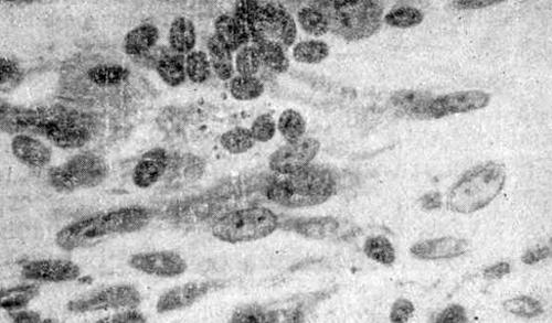 Мелкие безотростчатые клетки, сходные с симпатобластами в контрольной культуре симпатобластомы