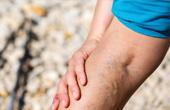Признаки варикозного расширения вен на ногах. Основные методы лечения заболевания