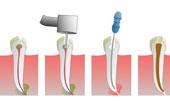 Методы пломбирования корневых каналов зубов