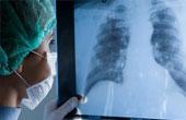 Детский рентген лёгких: особенности, показания, безопасность