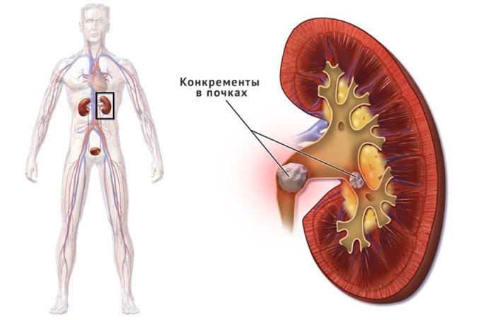 Камни в почках