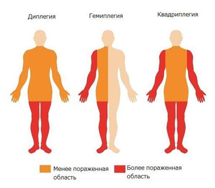 Спастическая диплегия ДЦП