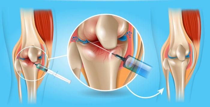 Гиалуроновая кислота как способ лечения суставов