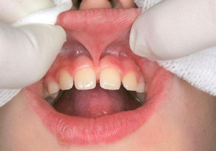 Френулопластика уздечки губы