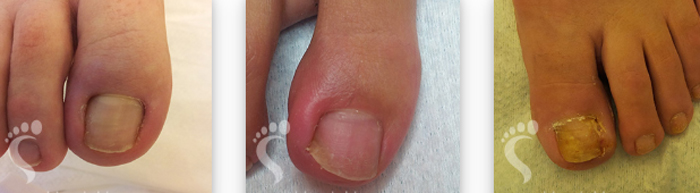 Лечение заболеваний на ногтях