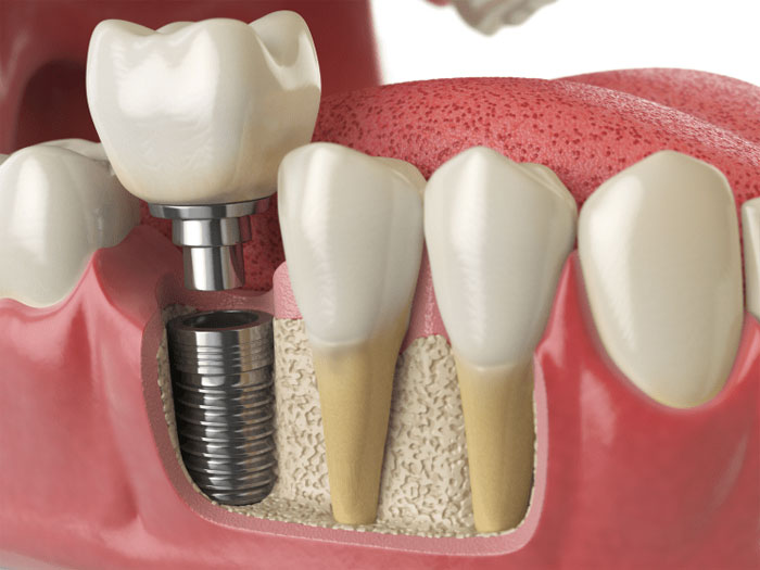 Имплантация зубов: показания и методы восстановления зубного ряда